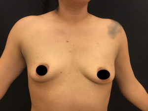 Breast Augmentation