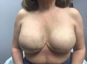 Breast Reconstruction