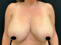 Breast Reconstruction