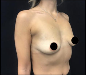 Breast Augmentation