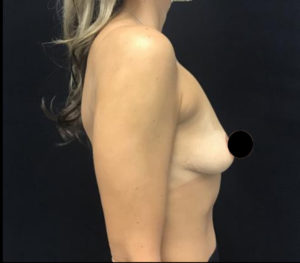 Breast Augmentation