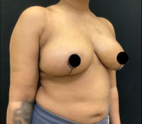 Breast Reduction