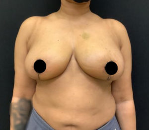 Breast Reduction