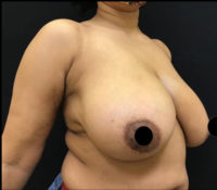 Breast Reduction