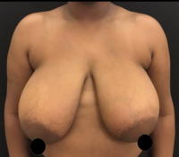 Breast Reduction