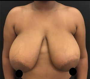 Breast Reduction