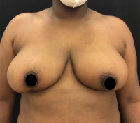 Breast Reduction