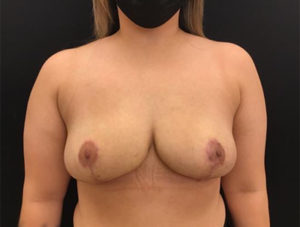 Breast Reduction