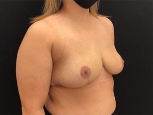 Breast Reduction