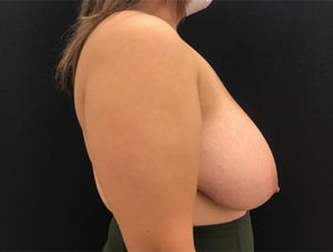 Breast Reduction