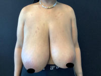 Breast Reduction