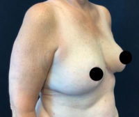 Breast Reduction