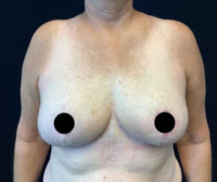 Breast Reduction