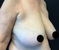 Breast Reduction