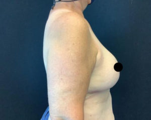 Breast Reduction