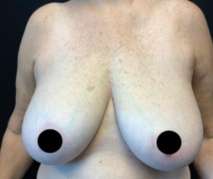 Breast Reduction