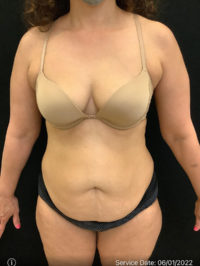 Tummy Tuck