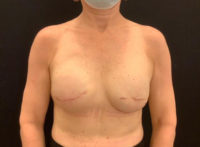 Breast Reconstruction