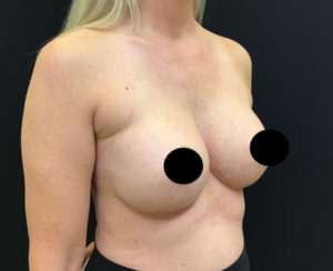 Breast Augmentation