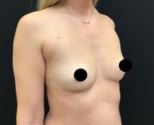 Breast Augmentation