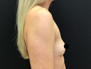 Breast Augmentation