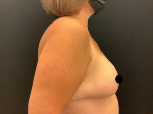 Breast Reduction