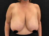 Breast Reduction