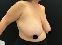 Breast Reduction