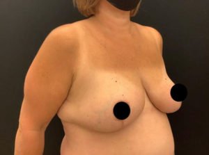 Breast Reduction