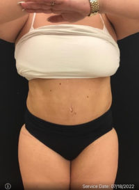 Liposuction