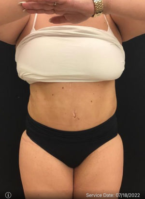 Liposuction