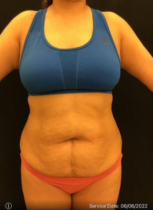 Tummy Tuck