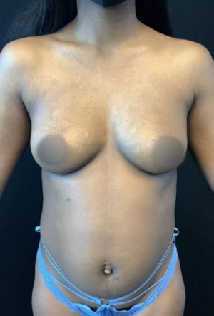 Breast Augmentation