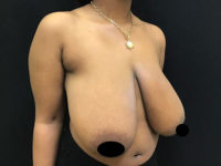 Breast Reduction