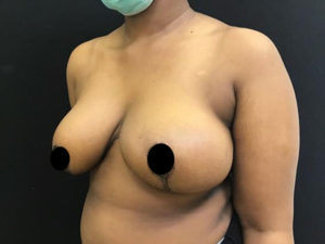 Breast Reduction