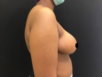 Breast Reduction