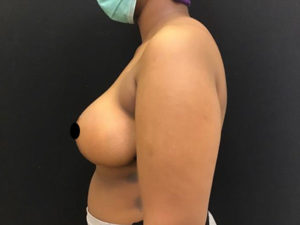 Breast Reduction