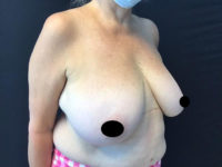 Breast Reduction