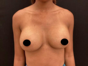 Breast Augmentation