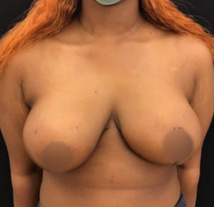 Breast Reduction