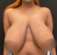 Breast Reduction