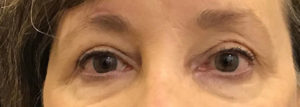 Upper Eyelid Blepharoplasty