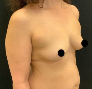 Fat Grafting to Breast