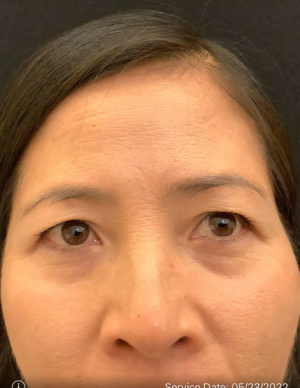 Upper Eyelid Blepharoplasty