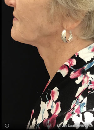 Neck Lift