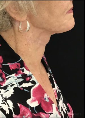 Neck Lift