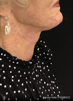 Neck Lift