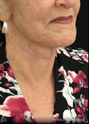 Neck Lift