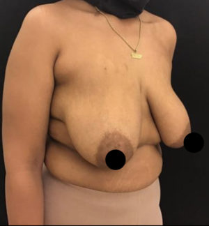 Breast Lift