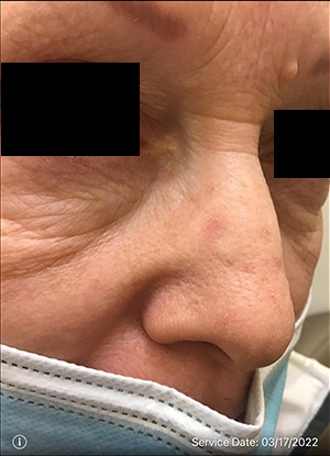 Basal Cell Carcinoma